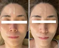 ㊗️周年記念‼️【¥33,000→¥28,600   期間中何度でも🆗】桁違いの高濃度幹細胞×テラボーラー×テラパック