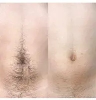 激安価格！きちんと抜ける！女性全身脱毛vio顔込み