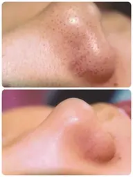 【鼻のみ】黒ずみ・ブツブツ・ザラザラが気になる方に✨毛穴の汚れをゴッソリ‼️ツルツルの毛穴レス♡