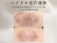 毛穴洗浄◇ハイドロフェイシャル【韓国肌パック仕上げ/鎮静・消炎】