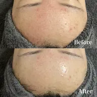 🔮【ニキビ・赤み・小顔ケア】 REVIハーブピーリング《陶肌トリートメント》 ➕ IPSPセラム➕VCF0.4ml