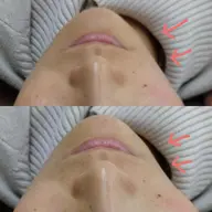 小顔ぷる肌　2回分★　人気!!光フェイシャル