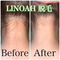 ◎3月限定◎【背中ニキビケア/毛穴】 背中全体＋うなじ脱毛 ￥14960⇒¥5980