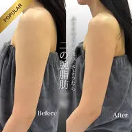 【人気No.1】5cc | 顎下・二の腕・部分集中サイズダウン🔥