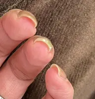 手の巻き爪が気になる方:モニター様募集