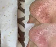 【期間限定|特別価格✨】毛穴改善|毛穴エクストラクション|tete式