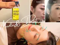 【脂肪がなくなる!?美容鍼】鍼灸初！脂肪サヨナラ👋美容鍼｜クリニックじゃなくて夢は叶う✨両頬・二重顎をスッキリ！