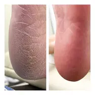 フット角質ケア