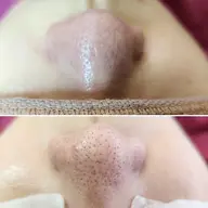 小鼻の黒ずみごっそり🫧小鼻ツルツル✨毛穴エクストラクション
