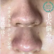 【取れた角栓が見える★】ミニモ限定★毛穴エクストラクション+その場で作る生パックプレゼント