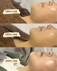 《脂肪を減らしたい方》🇰🇷で話題🍋脂肪細胞アプローチ導入液×超音波導入✨