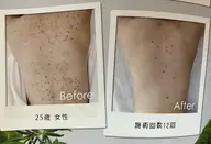 最安価75分<リベルハーブピーリング>剥離なし3倍の効果！(背中上、背中下、デコルテ、二の腕、ヒップ) ブライダルの方も