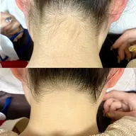 【えりあし脱毛】何度でも利用OK