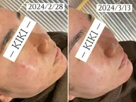 【68％オフ‼️】【ハーブピーリング｜毛穴黒ずみケア◎】カウンセリング込み120min(31,900円→10,000円)