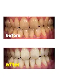 【ミニモ限定】セルフホワイトニング 集中3ヶ月コース