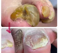 巻き爪、肥厚爪、陥入爪、魚の目ケア、タコケア爪トラブルご相談受けます🙆