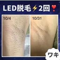 脱毛🌿両わき
