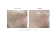 【夏前ケア✨】全身美脱毛（顔+vio）＋美肌フェイシャル