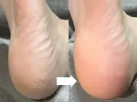 【フットケア】ガサガサかかとに◆フットスパ¥3500 ※角質除去のみ¥2200