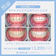 【初回限定・白さを極める】真っ白お約束･ ライトプレミアムホワイトニング❣〈合計 60分照射 2 来店〉❣