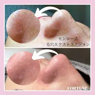 minimo特別価格✨小鼻の黒ずみ撃退！！モンロー式毛穴エクストラクション