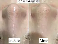 人気No.3内側から潤う《高濃度VC導入付き》毛穴洗浄ハイドロfacial🫧