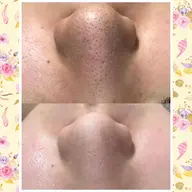 🍓鼻を撲滅❗毛穴クリーンケア　モニター価格！