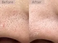 【ハーブピーリング2カ所お試し】剥離無orブレンドハーブピーリング¥18000→