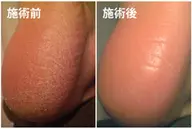 かかと角質取り