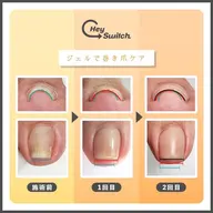 巻き爪ケア(1本)