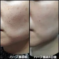 【肌荒れ/ニキビが気になる方へ】美肌を土台から育てる！ハーブ+無料エステ付