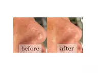 【鼻の黒ずみ・メラニン毛穴に】鼻脱毛+毛穴ケア🫧