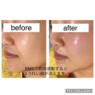 針を刺さないボトックス？！深部へ医療用電気でピュアコラーゲン&ヒアルロン酸をチューブ丸々1本導入✨