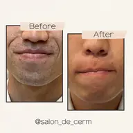 初回【期間限定】全身脱毛特別価格✨