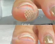 【フット】両親指のみ巻き爪ケア