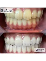 【👑人気No.1👑】 5分照射×2回🦷通常の約2倍の照射パワー🔥最新高速ハイパワーセルフホワイトニング🎶