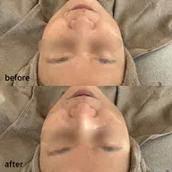 ハーバルフルーツピーリング ✩.*˚ ハリ、ツヤ激変!肌質改善