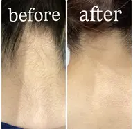 自分ではケアが届かない【うなじ・背中脱毛】お試し4,000円