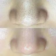 〈Aプラン〉毛穴ゼロシンプルコース