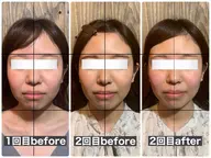 🌸破格限定クーポン🌸ほんとはみんな小顔なんです❣️小顔矯正 × シンクロウェーブ