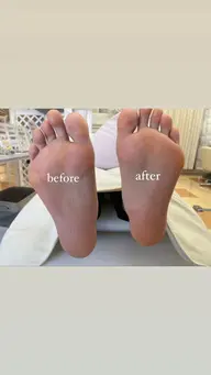 フット角質ケア🦶