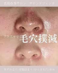 【施術人数4万人突破記念✨いちご鼻・角栓・ひらき毛穴撃退！】毛穴肌管理フェイシャル🉐ミニモ限定