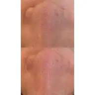 毛穴フェイシャルエステ