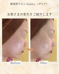 【くすみ集中ケア☆】ダウンタイムなしハーブピーリングで、1回でもわかる透明感♪つるんと素肌へ✨