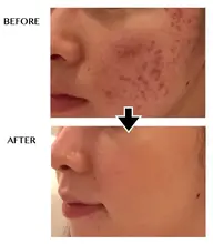 サーマナイフフェイシャル　超肌質改善