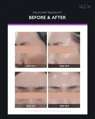 仮予約【3Dツヤ美白ピーリング🥚✨】今あるシミ、これからできるシミ予防に◎内側から発光するクリア肌へ🥚✨