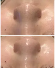 【毛穴汚れ撃退!】美容液で洗う韓国ハイドラ毛穴洗浄+パック付き ¥5,500 ※4月7日よりご予約可