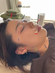 【ミニモ限定】U24学割!美容鍼💆🏻♀️(通電あり•なし)