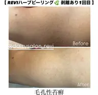 背中上・背中下・肘下・肘上・膝下・膝上・お尻・お腹・デコルテ・バスト 【 お好きな箇所 】REVIハーブピーリング🌿