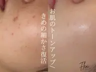 【カサカサ肌からツヤ肌へ】乾燥・肌荒れ改善ピーリングコース